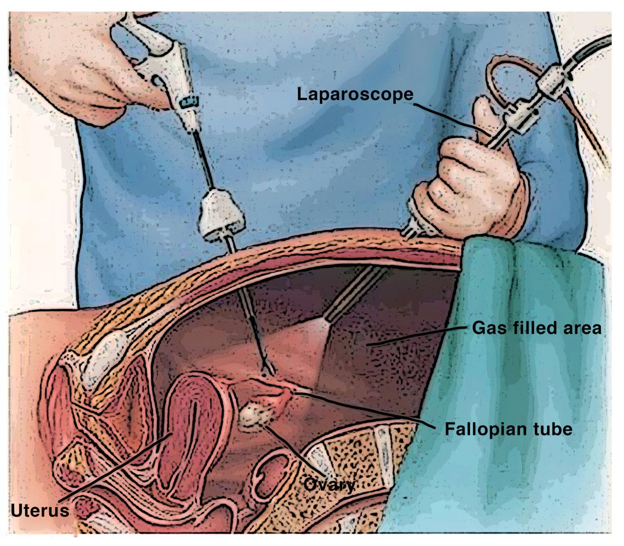 Lysis of adhesions laparoscopic cpt