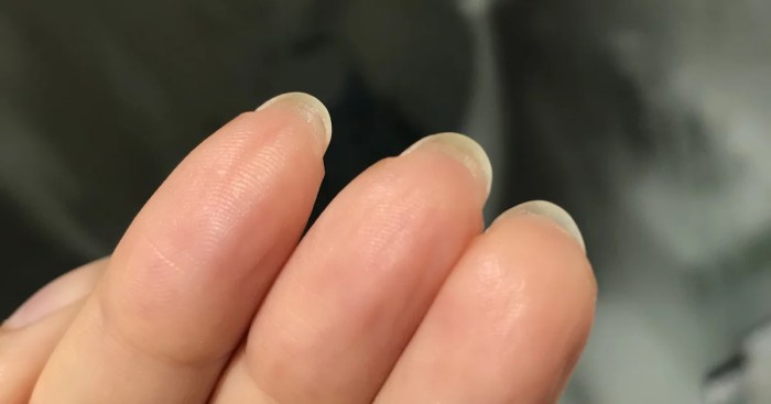 Replacement of a natural fingernail takes about